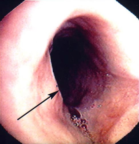 An upper esophageal web (arrow) in a patient with Plummer-Vinson syndrome.