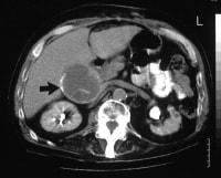 A transaxial enhanced computed tomography (CT) sca