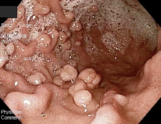 polyps in nose. What Causes Gastric Polyps