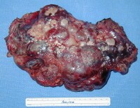 Steroid use in alcoholic liver disease