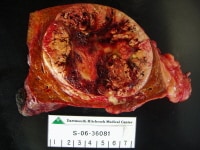 Hepatocellular Cancer