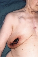 Wound infection due to disturbed coagulopathy. Th...