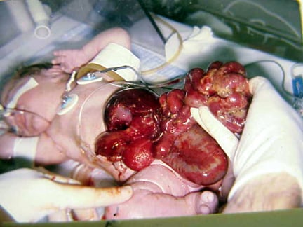 In this baby with gastroschisis, the bowel is unc...