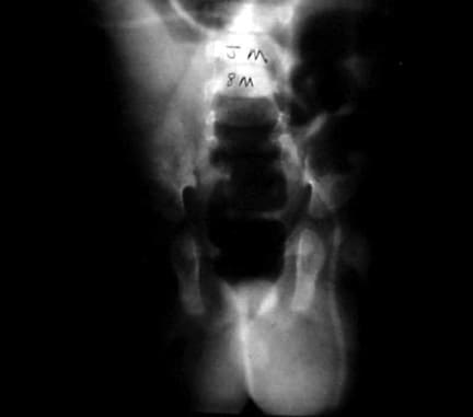 A 6-month-old boy with a ventriculoperitoneal shu...