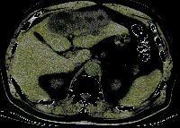 Tính chụp cắt lớp (CT scan) phát hiện của gan ab
