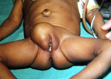 A 3-month-old girl with a large right inguinal he...