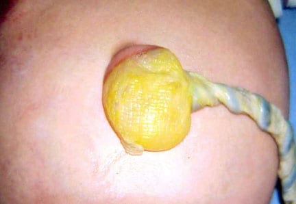 Hernia of the umbilical cord.