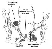 Anorectal Abscess Images