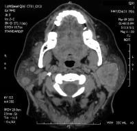 Parotid Masses