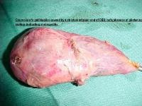 distended gallbladder