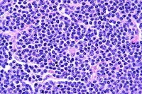 Mantle cell lymphoma. Small lymphoid cells with ov