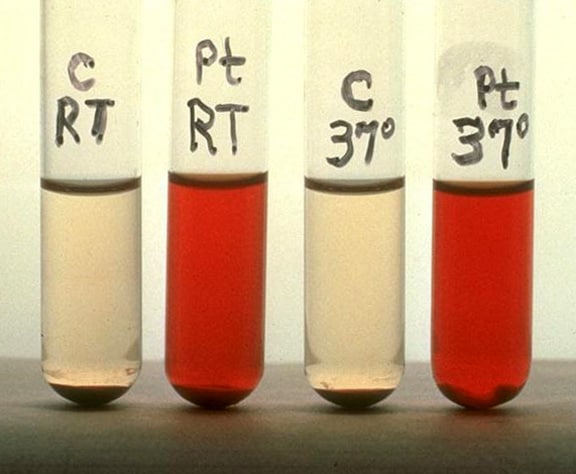 Here is a PNH patient's (Pt) red blood cells lysed by normal serum at room 