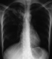 Anteroposterior chest radiograph in a young ED pat