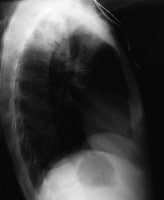 Lateral chest radiograph in a 31-year-old patient 