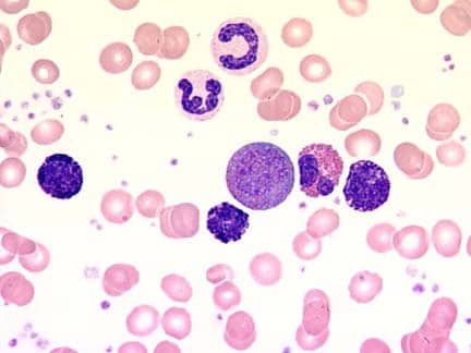 Blood film at 1000X magnification shows a promyel.