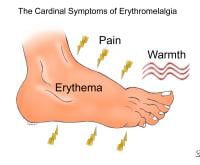 Erythromelalgia - Pictures, Symptoms, Causes, Treatment