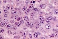 Diffuse large B-cell non-Hodgkin lymphoma. Large c