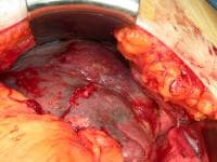 This patient has a splenic abscess due to pneumoco