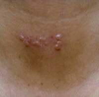 Herpes zoster on the neck. 