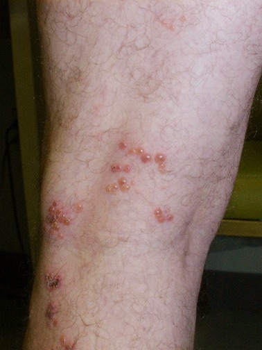 Herpes on my lower leg - STDs - MedHelp