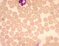 Babesiosis Workup