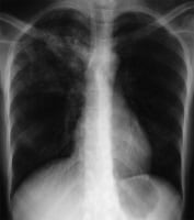Anteroposterior chest radiograph in a young ED pat