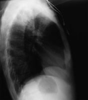 Lateral chest radiograph of a patient with posteri