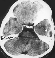 Chronic mastoiditis and epidural empyema in a pati