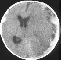 Subdural empyema and arterial infarct in a patient