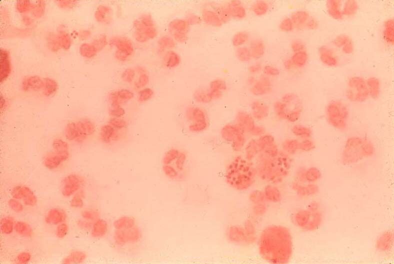 very young bude girls gonorrhea in the mouth