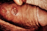 Syphilitic chancre