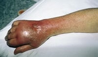 Cellulitis Of Hand