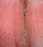 A moist, erosive, pruritic patch of perianal skin 