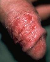 Dry, red, superficially scaly, pruritic macules a...