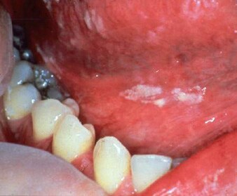 White plaques are present on the  buccal mucosa an...