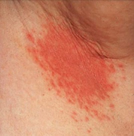 Erythema, maceration, and  satellite pustules in t...