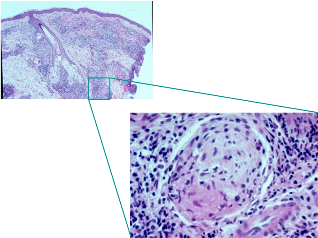 Histopathology of leprosy: Large numbers of acid-fast bacilli (in clusters) 