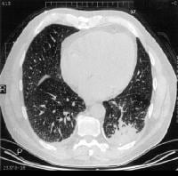 Mucormycosis Workup