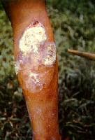 Bejel Disease
