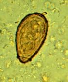 Trematode infection. <em>Clonorchis sinensis</em>...