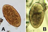 Trematode infection. <em>Fasciola hepatica</em> e...