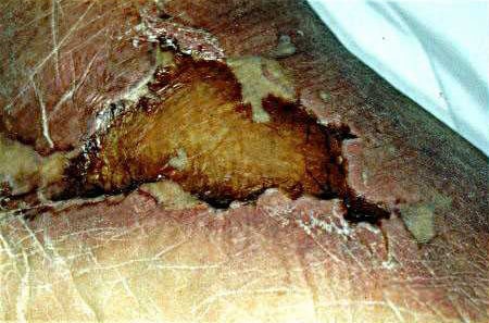 In a patient with cirrhosis, skin lesion rapidly becomes necrotic.