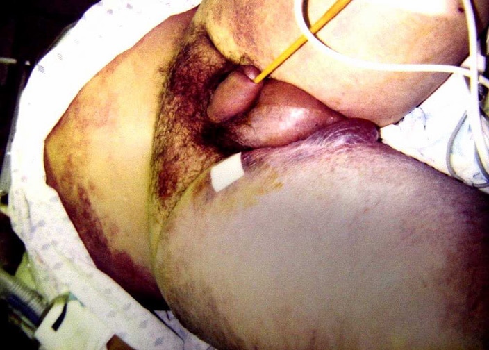 Bullous lesions in a patient with cirrhosis continue to progress, 