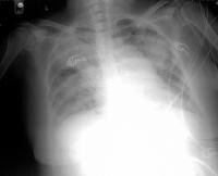 Typical chest radiograph of a patient with nosocom