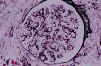 Nephrosclerosis. Glomerulus with wrinkling of glom