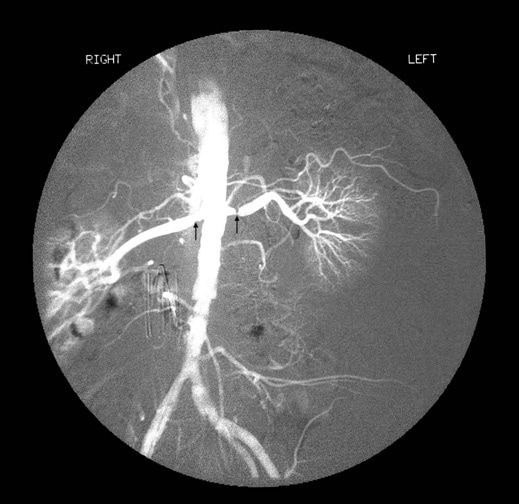 ace inhibitor renal artery stenosis