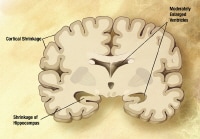 Mild Alzheimer disease. The disease begins to affe