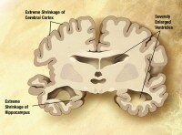 Severe Alzheimer disease. In the last stage of AD,