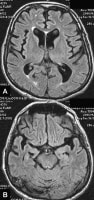 frontotemporal dementia.