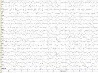 cjd eeg findings